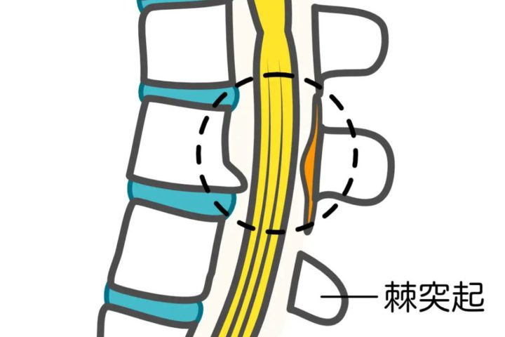 脊柱管狭窄症