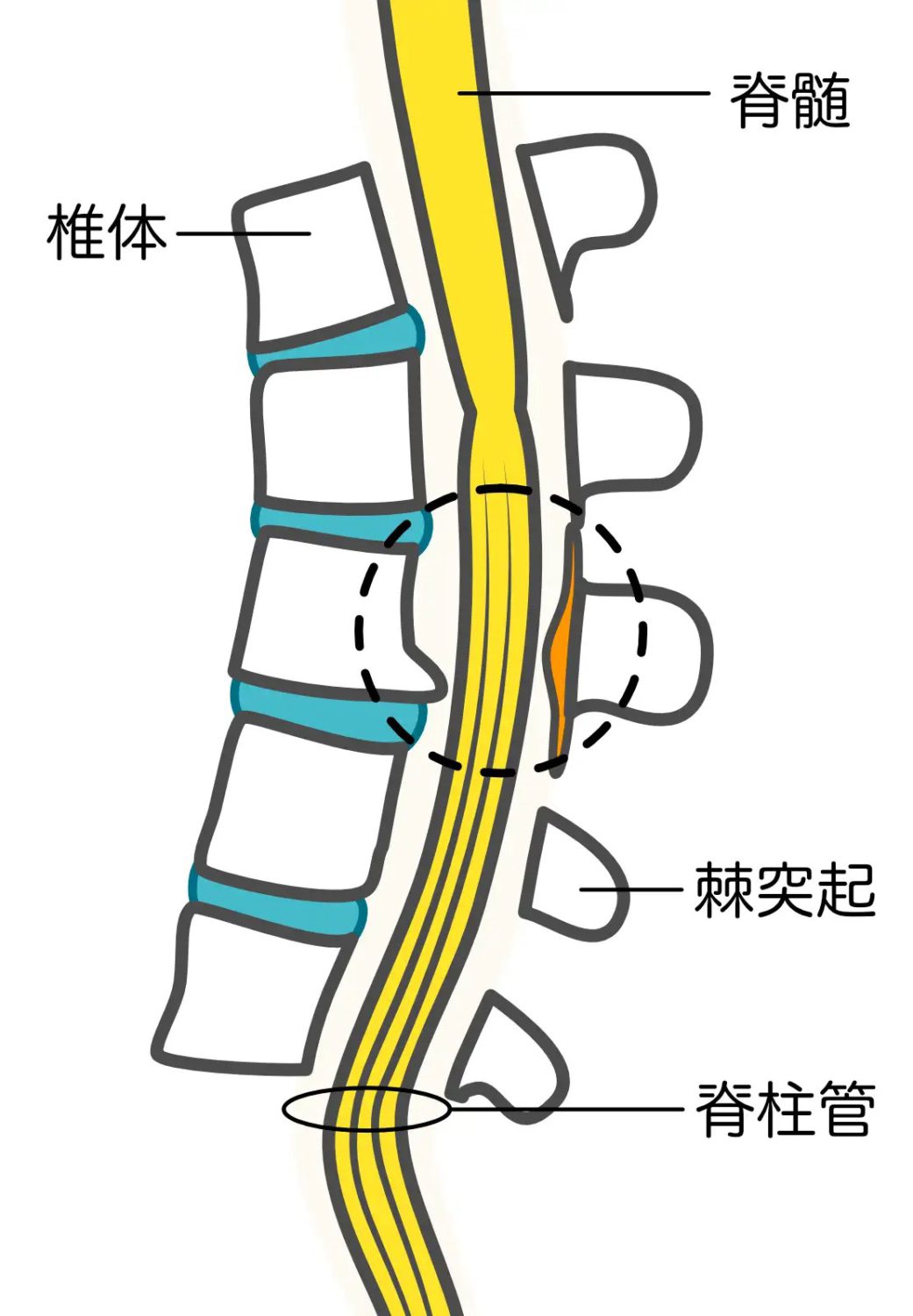 脊柱管狭窄症